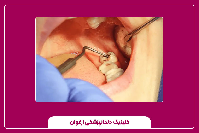 کشیدن دندان عقل