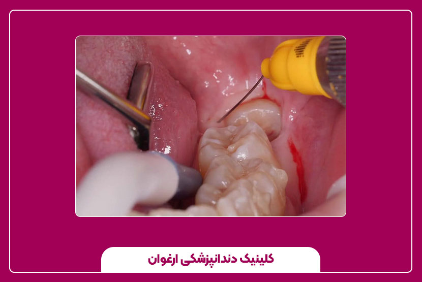 استفاده از لیزر در ترمیم دندان عقل