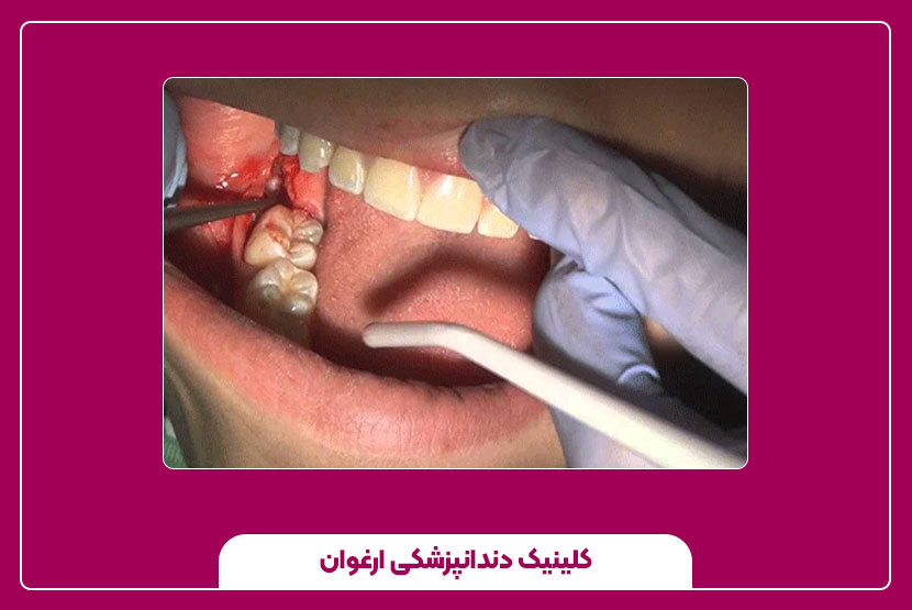 مقایسه هزینه و مدت زمان روش‌های مختلف ترمیم دندان عقل