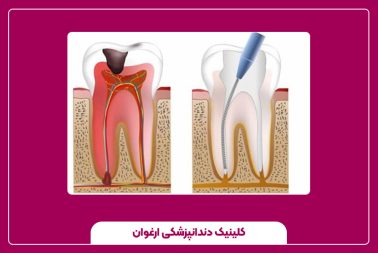 دلایل و راه‌های درمان درد دندان عصب‌ کشی شده