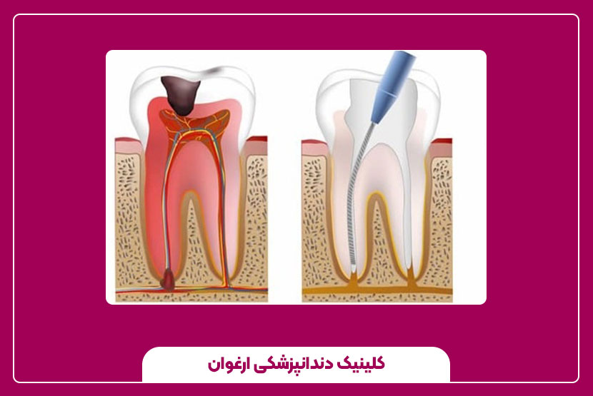 دلایل و راه‌های درمان درد دندان عصب‌ کشی شده