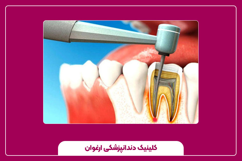 راههای درمان درد دندان عصبکشی شده