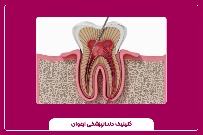 چگونه از درد پس از عصبکشی جلوگیری کنیم؟