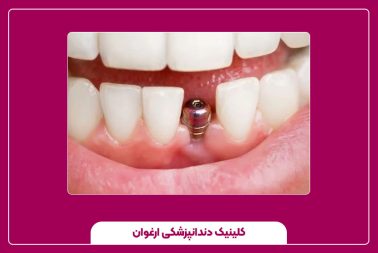 روش‌های کاشت جوانه دندان