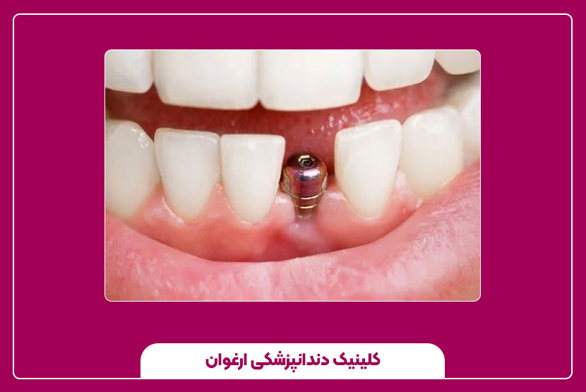 روش‌های کاشت جوانه دندان