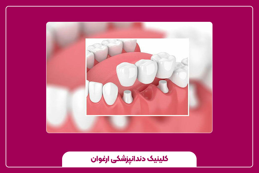 انتخاب تکنیک مناسب کاشت جوانه دندان