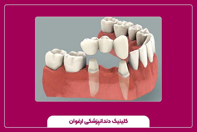 مراقبتهای بعد از کاشت جوانه دندان