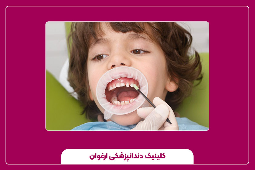 چه زمانی کشیدن دندان دائمی کودکان ضروری است؟