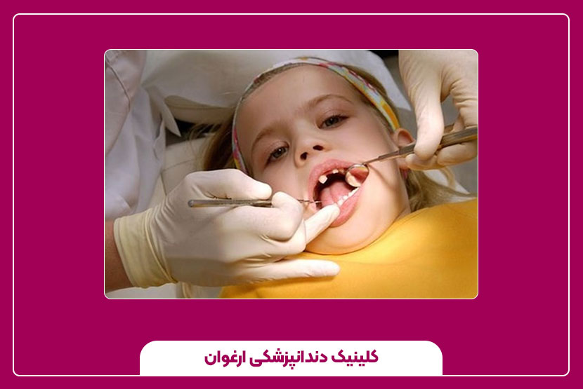 مراقبت‌های بعد از کشیدن دندان دائمی در کودکان