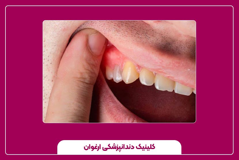 علائم التهاب لثه