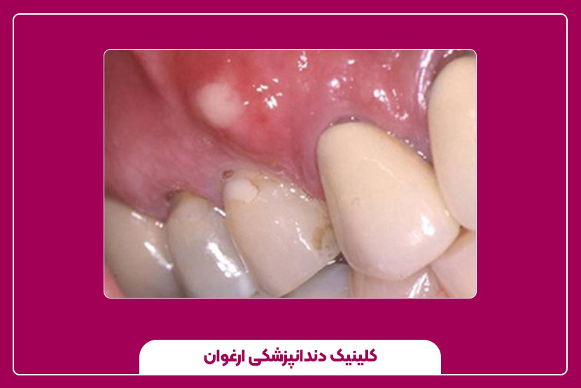 تشخیص و مراحل بیماری