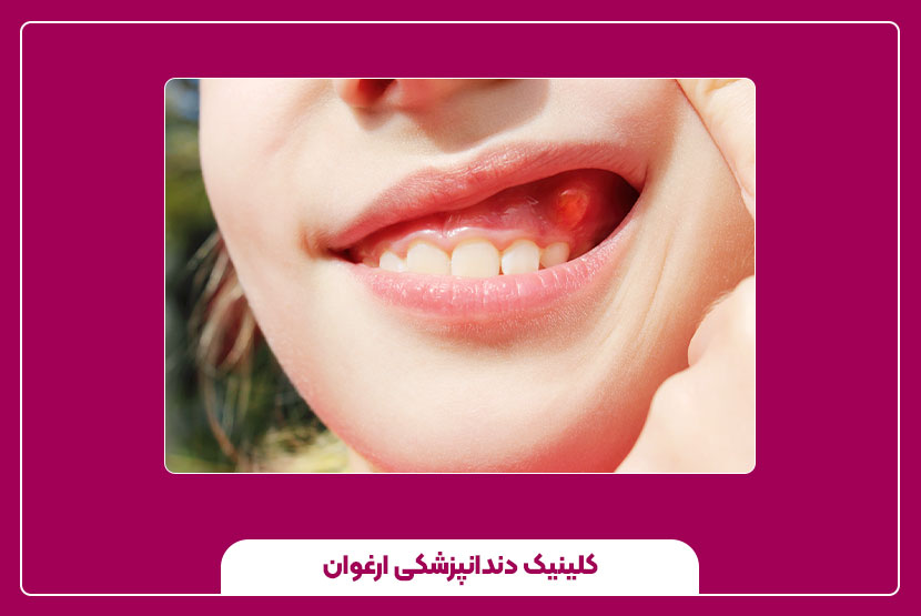 درمان التهاب لثه