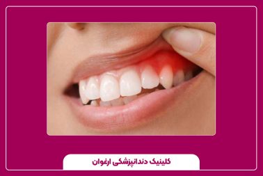 علت التهاب لثه و راه‌های پیشگیری از آن