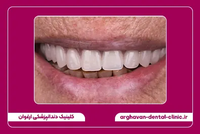 ایمپلنت بعد