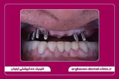 ایمپلنت قبل