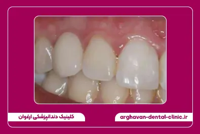 ایمپلنت با روکش زیرکونیم بعد