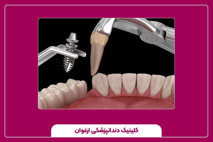 قیمت ایمپلنت دندان و عوامل تاثیرگذار بر آن