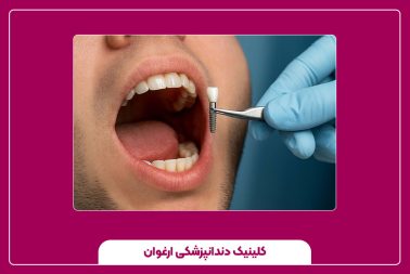 ایمپلنت دندان؛ زیبایی و استحکام