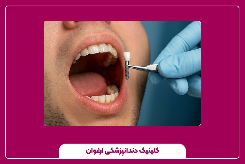 ایمپلنت دندان؛ زیبایی و استحکام