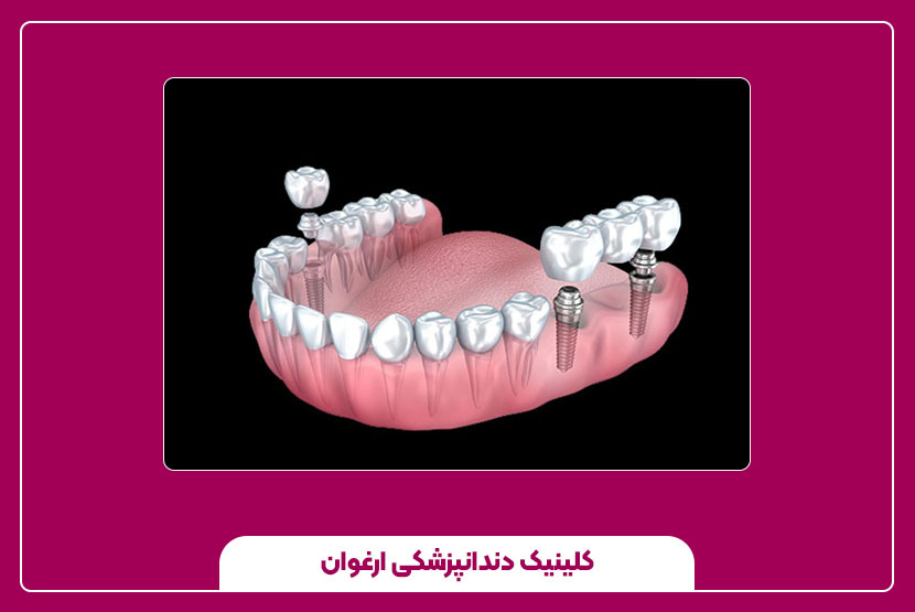 مزایا و معایب ایمپلنت دندان