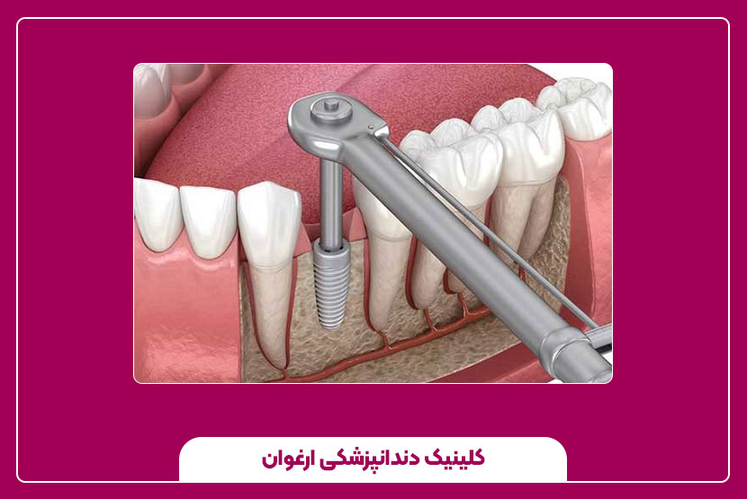 مراقبت بعد از کاشت ایمپلنت دندان