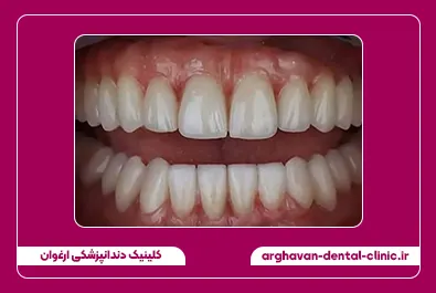 ایمپلنت و کامپوزیت بعد