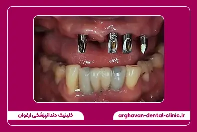 ایمپلنت و کامپوزیت قبل