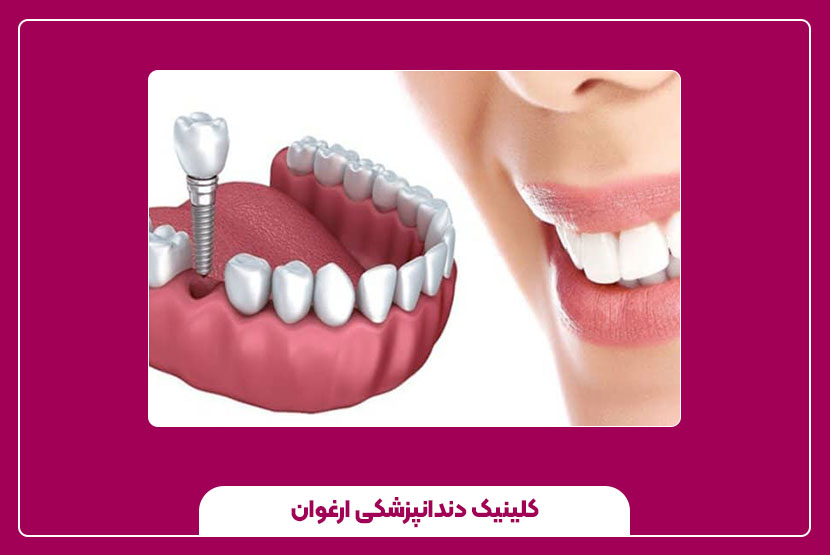 روند درمان در ایمپلنت یک‌ روزه