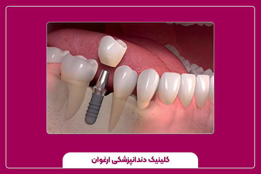 تفاوت ایمپلنت یک‌ روزه با ایمپلنت معمولی