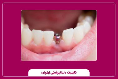 تفاوت ایمپلنت یک روزه با ایمپلنت معمولی