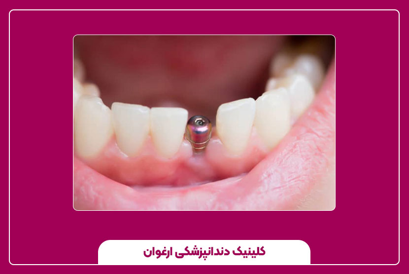 تفاوت ایمپلنت یک روزه با ایمپلنت معمولی