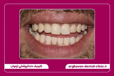 بستن فاصله با کامپوزیت بعد