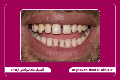 بستن فاصله با کامپوزیت قبل