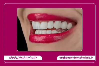 بستن فاصله با کامپوزیت بعد