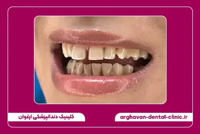 بستن فاصله با کامپوزیت قبل