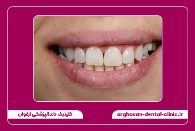 بستن فاصله با کامپوزیت بعد