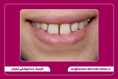 بستن فاصله با کامپوزیت قبل