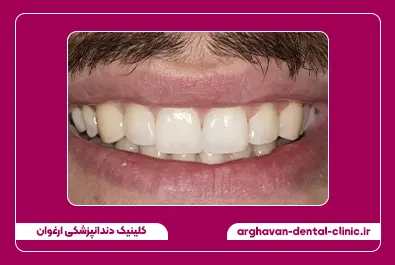 بستن فاصله با کامپوزیت بعد