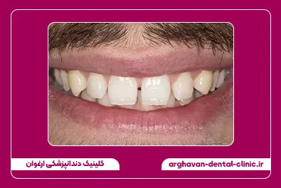 بستن فاصله با کامپوزیت قبل