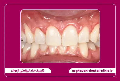 بلیچینگ بعد