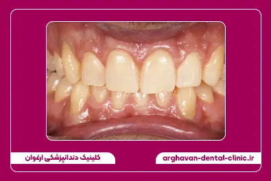 بلیچینگ قبل