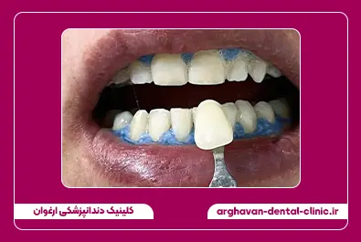 بلیچینگ بعد