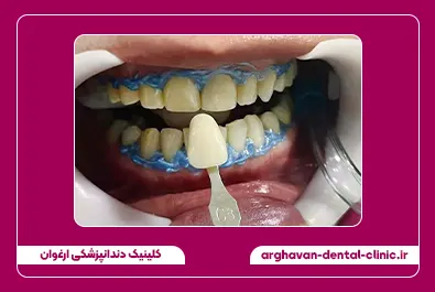 بلیچینگ قبل