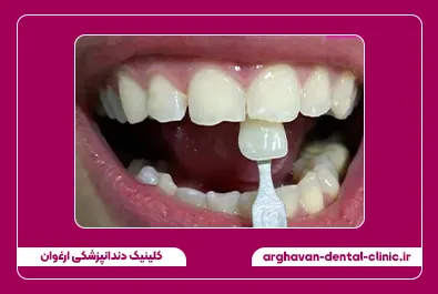 بلیچینگ بعد