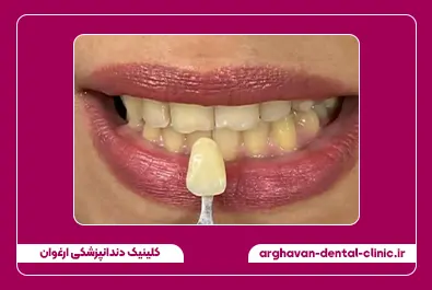 بلیچینگ قبل