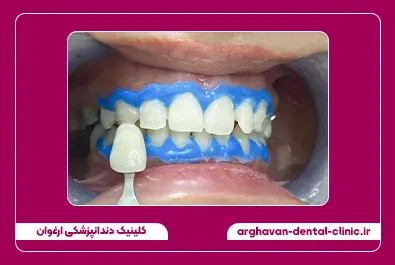 بلیچینگ بعد