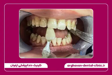 بلیچینگ قبل