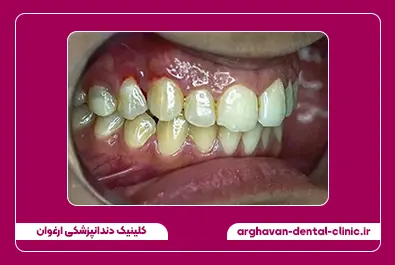 بلیچینگ قبل