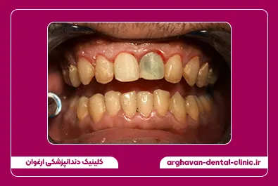 بلیچینگ داخت دندانی و کامپوزیت قبل