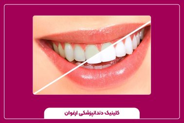 میزان سفیدی دندان با بلیچینگ دندان چقدر است؟